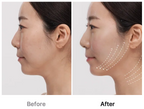 Medicube [Collagen RF] UltraTune 40.68, 1 Unit