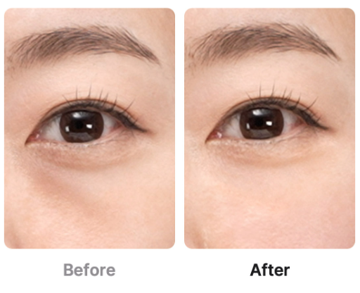 Medicube [Collagen RF] UltraTune 40.68, 1 Unit